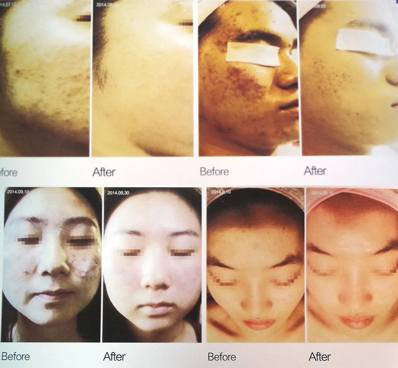 Detachable 7 Color LED Photon Spectromete Skin Rejuvenation Acne Remover Anti-wrinkle Facial Machine Photon Skin Care SPA Device