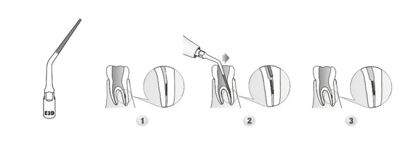 1 набор стоматологических наконечников Endo Kit EEKS fit EMS дятел SYBRONENDO с Endo Tip Endodontic instrument