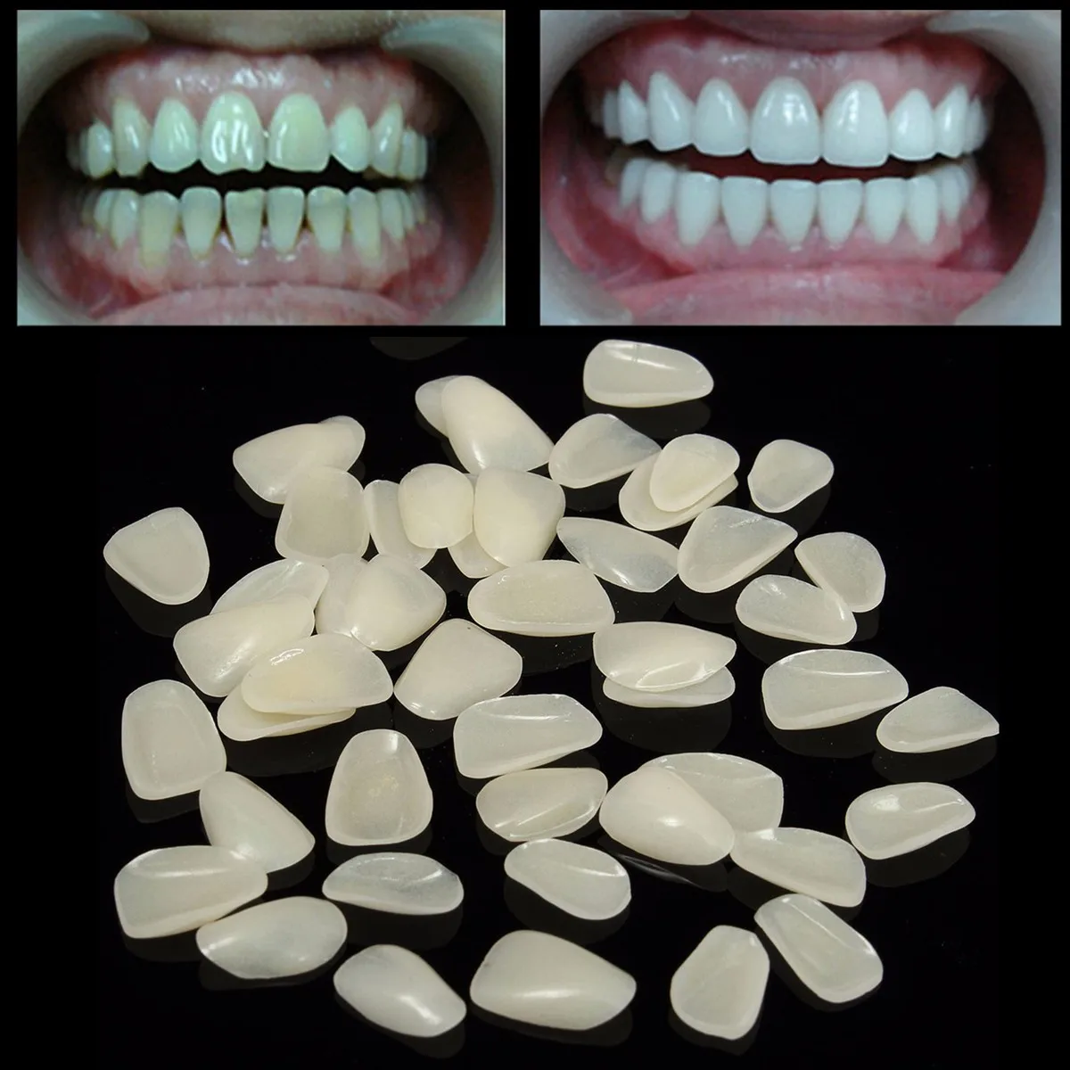 

100pcs Dental Temporary Crown Resin Porcelain Materials Anterior Shade Teeth Molar Tooth Veneers Provisionals Ultra-Thin