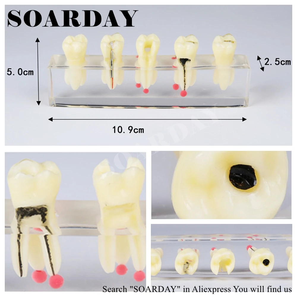 SOARDAY зуб корневого канала Восстановление Модель Устные зубные учебные материалы зуб нерва модель