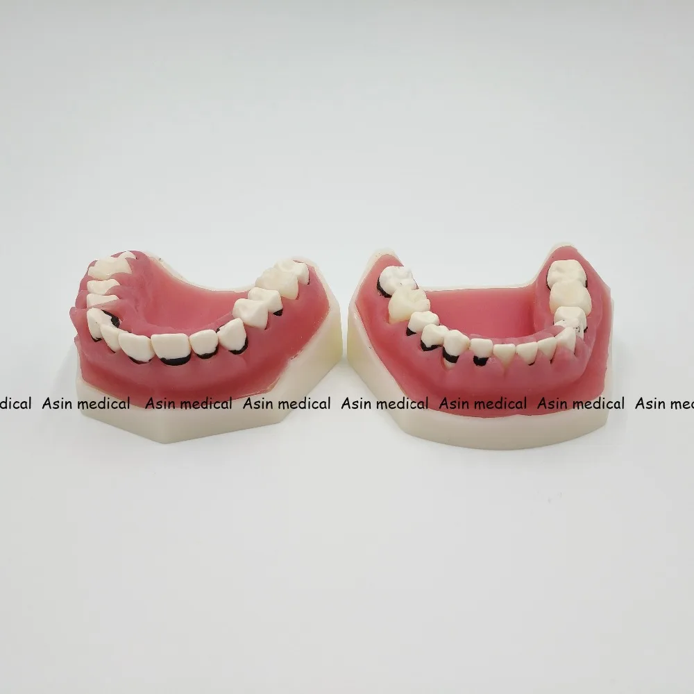 Modelo de Aprendizagem Modelo de Doença Deasin Novo Dentista Periodontal Dente - Modelo Médico 7 Deasin novo modelo de aprendizagem dentista, modelo