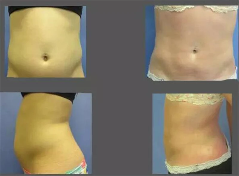 Máquina de Emagrecimento Nova Mini Lipoaspiração Lipo Portátil Uso Doméstico Corpo Frio Moldar 2019 12 Computers & Electronics