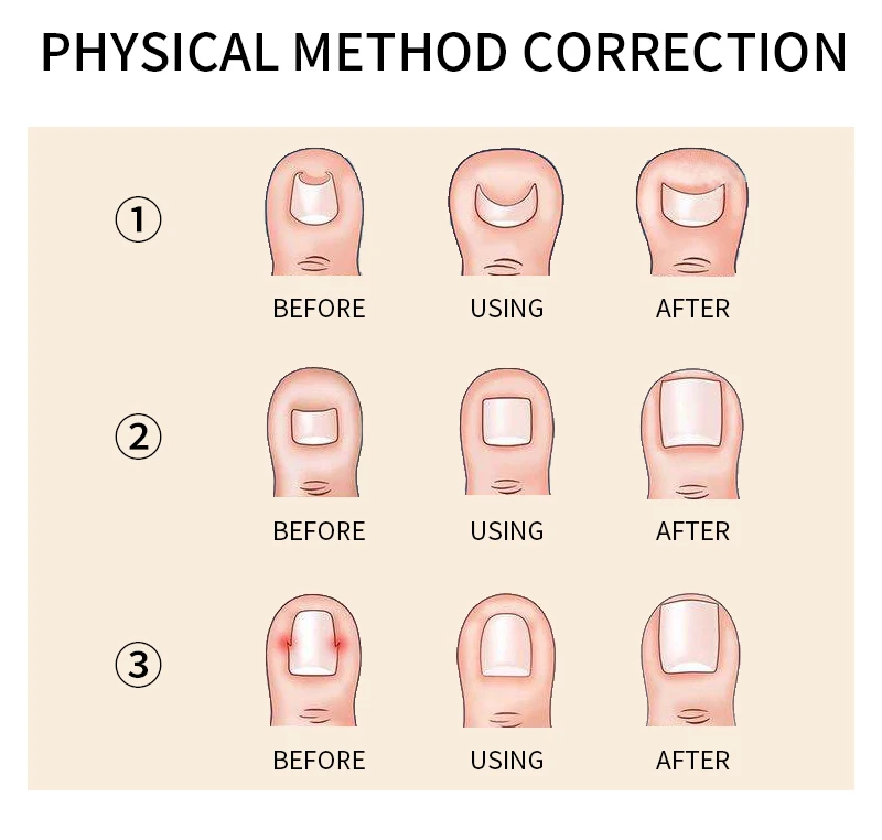 Вросший носок ногтей восстановление коррекция Инструмент Педикюр закрепитель для ногтей на ногах Уход за ногтями на ногах инструмент ортопедический ногтей Корректор для педикюра инструмент FT52