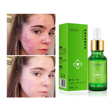

20ML Net Acne Smoothing Essence Acne Pit Acne Cream Products Stubborn Acne Remove Essence Facial Care