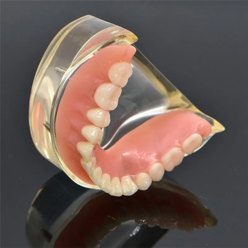 Mandibulares com Implante de Dente Modelo Teeth Dental Overdenture Removível Interior Mandibular Inferior Estudo Ensino Modelo Dentes 12 Dentes dentários dentários modelo interior removível mandibular
