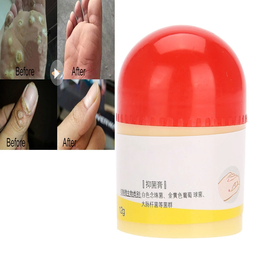 Набор для удаления бородавок Verruca Plantaris Teatment лечение китайской медициной антимикробный крем+ клейкие бинты+ ватный тампон
