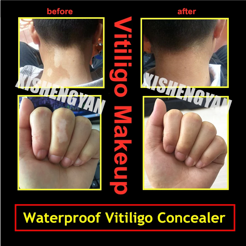 Vitiligo Makeup Pen – Long Lasting Waterproof White Patches Camouflage Concealer_SHUIYIN