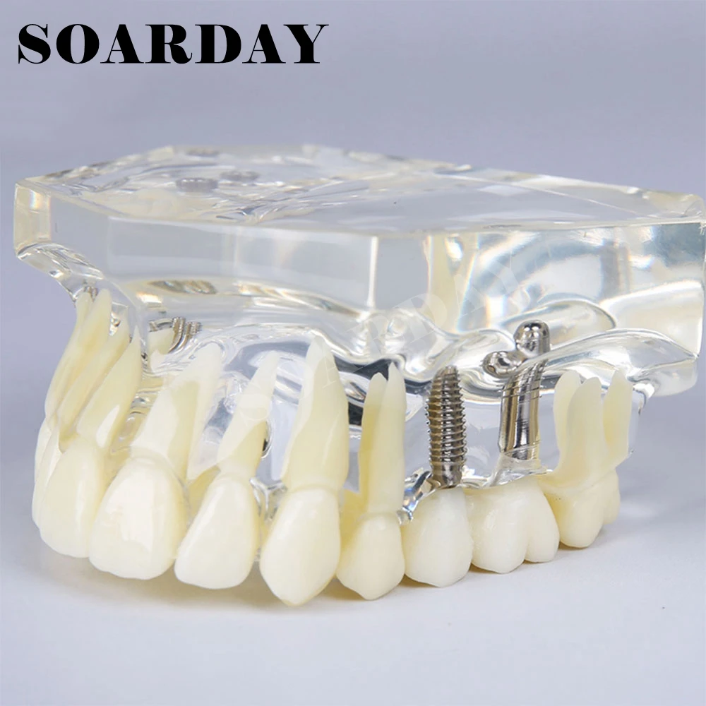 Horní zubní implantát Zubní model s mostem pro výuku nebo komunikaci