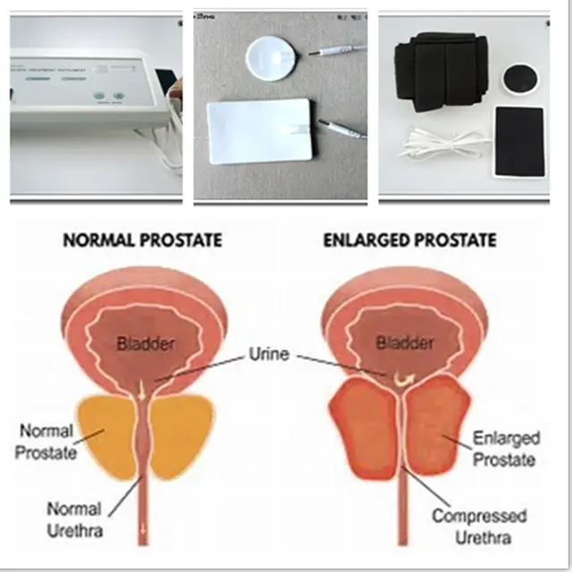 imágenes de ultrasonido prostatitis