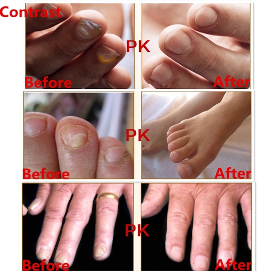 AFY Toenail Fungus Treatment Serum Foot Toe Nail Fungus Treatment Fungal Nail Cure Toenail Fungus Infection Onychomycosis Remove