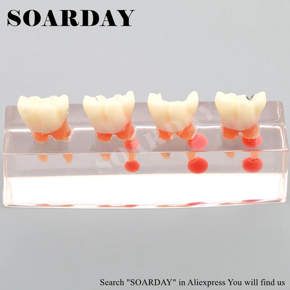 Dental Endodontic Restoration Model (2)