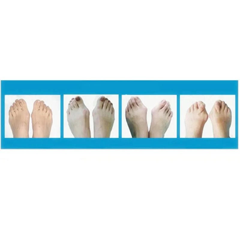 1Pair LittleToe Pinkie Thumb For Daily Use Hallux Valgus Silicone Gel Toe Bunion Guard Foot Care Little Toe Toe Separator