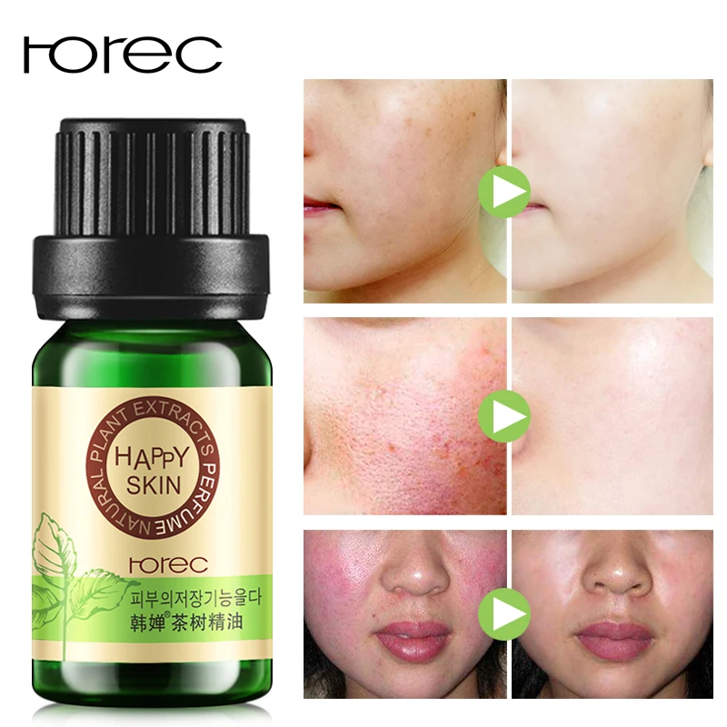 

ROREC Tea Tree Compound Essential Oil Face Care Skin Acne Treatment Oil-Control Blackhead Remover Anti Scar Spots Beauty