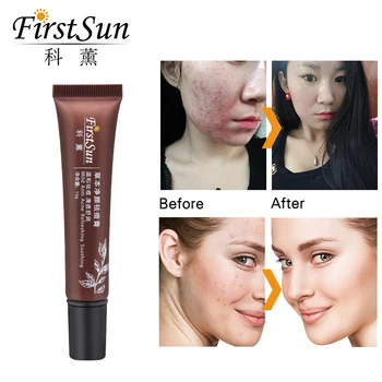 

Anti Acne Scar Remover Treatment Skin Lightening Face Whitening Cream for Dark Spots Melanin Pimple Pigmentation Removal Cream