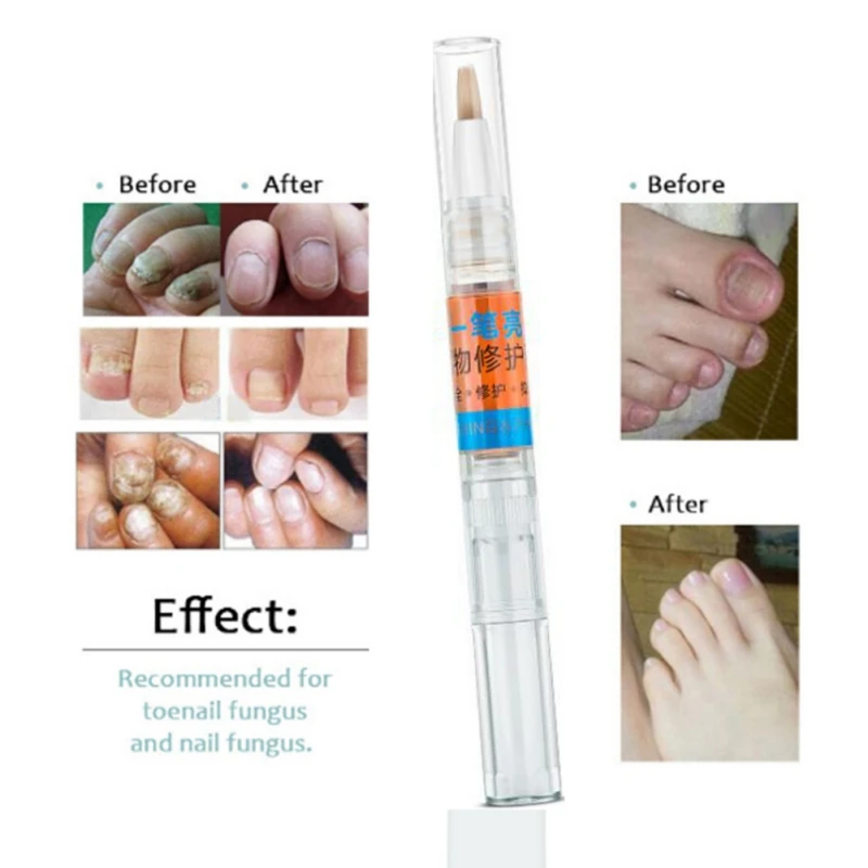 Fungal Nail Treatment Pen Essence Nail Foot Whitening Toe Nail Fungus Removal Feet Care