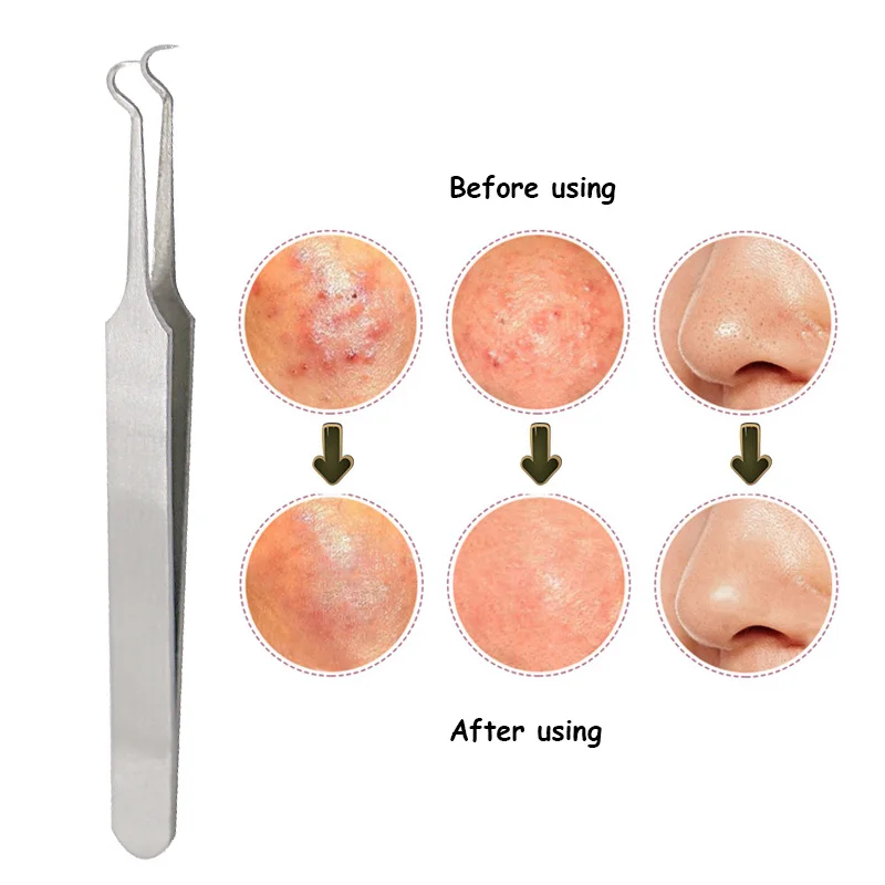 2/3/4/5 шт для удаления черных точек прыщей Угорь инструмент ложка для чистки лица Уход за кожей пинцеты для прыщей комедонов инструмент для удаления прыщей игла
