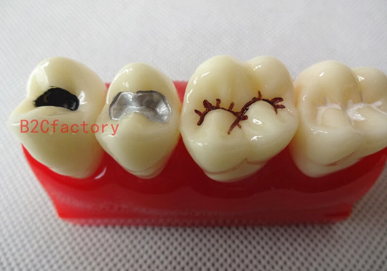 

Dental Pit and Fissure Sealing Treatment Teeth Tooth Study Learn Model 1piece