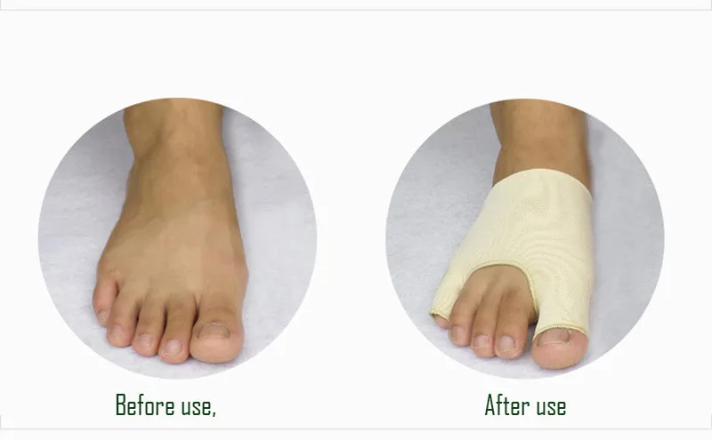 Выпрямить стопу. Выравниватель мизинца на ноге. Выпрямить стопу. Выпрямление пальца на ноге. Выпрямление ног операция.