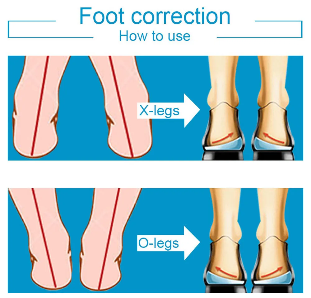 Sunvo гель O/X ортопедические стельки для ног коррекция вальгусной деформации варуса массаж ног ортопедические стельки Плоскостопие поддержка Вставки колодки