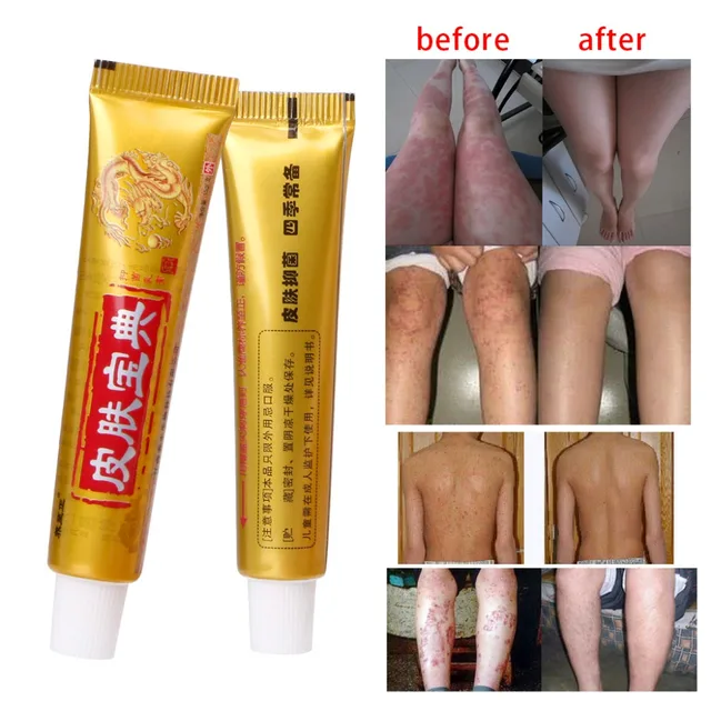 Natural Chinese Medicine Herbal Anti Bacteria Cream Psoriasis Eczema