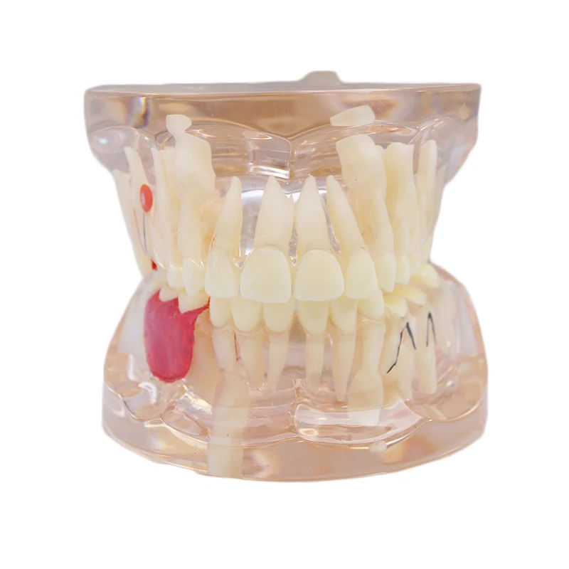 

1PC Dental Clinic Implant Disease Tooth Pathological Extrusion Clear Mixed with missing teeth model