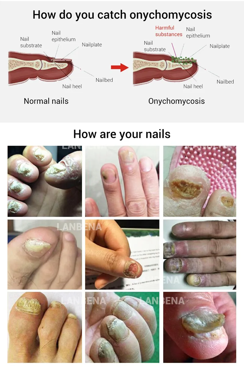 LANBENA Nail Care Gel Fungal Nail Treatment Remove Onychomycosis Nail Care Nourishing Effective against nail Hand And Foot Care LANBENA Nail Care Gel Fungal Nail Treatment Remove Onychomycosis Nail Care Nourishing Effective against nail Hand And Foot Care
