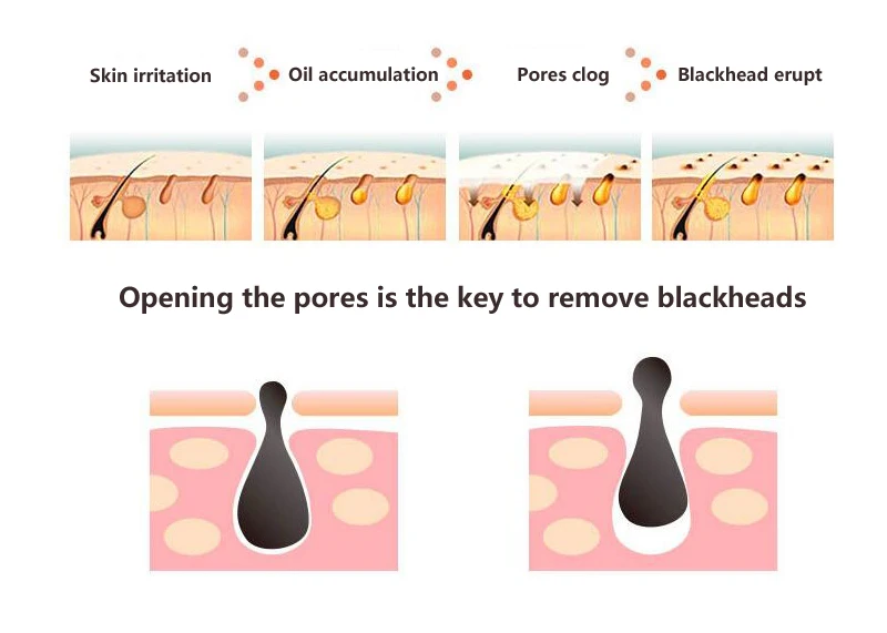acne remover