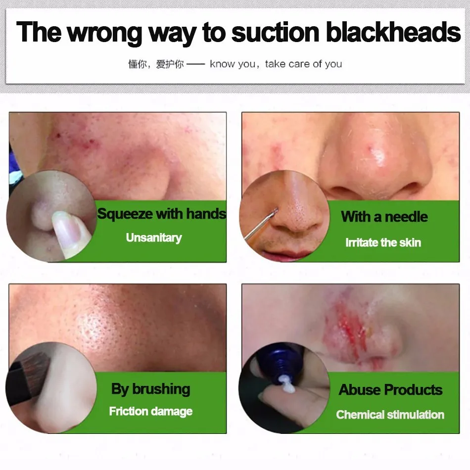 AFY всасывающая черная маска, маска для удаления черных точек, эффективное лечение угрей и черных точек от носа и щек