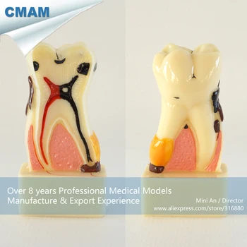 

DH/13072, 4Times Bigger Periodontal Disease, Pathology Dental Model, Medical Science Educational Teaching Anatomical Models