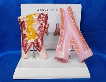 

1:1 Vascular Model of Smoking Arteries Comparison Smoking Vessels and Normal Vessels Model Human Vascular Medical Teaching Model