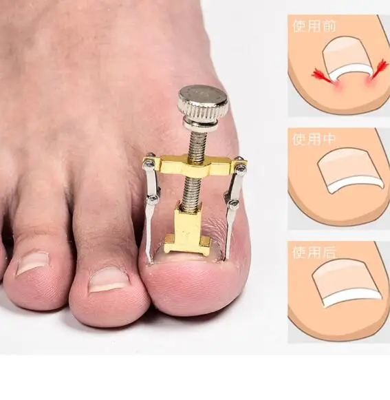 Выпрямитель для ногтей инструменты для коррекции вросших пальцев ног фиксатор для ногтя выпрямитель для восстановления зажима ножницы инструменты для лечения Ногтей LYQ
