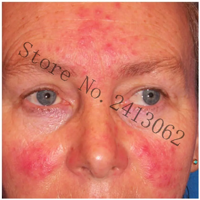 Жемчуг акне крем красный нос мазь Черноголовых Удалить Acne крем для ухода за кожей травяной анти-акне клещ розовые угри лечения shrink поры