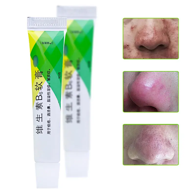 Крем Rosacea Китайский травяной для ухода за кожей лица средство удаления прыщей в