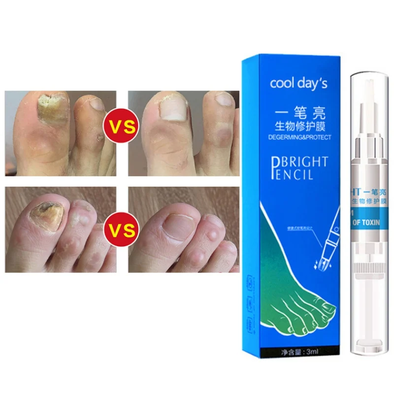 

Nail Fungal Treatment Pen Anti Fungus Infection Biological Repair Solution Nutritious Oil 3ml Restores Healthy Toenails