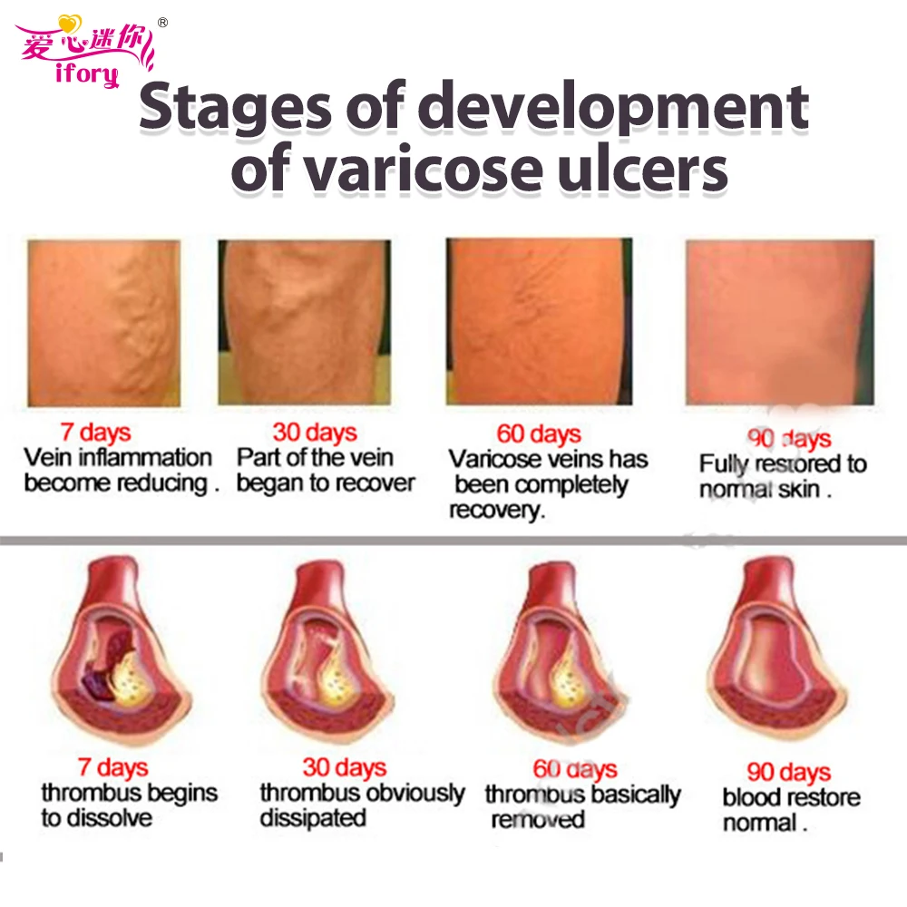 Ifory 2 короба Крем для лечения варикозного расширения вен китайский пластырь против васкулита ног Phlebitis травяной продукт медицинский пластырь