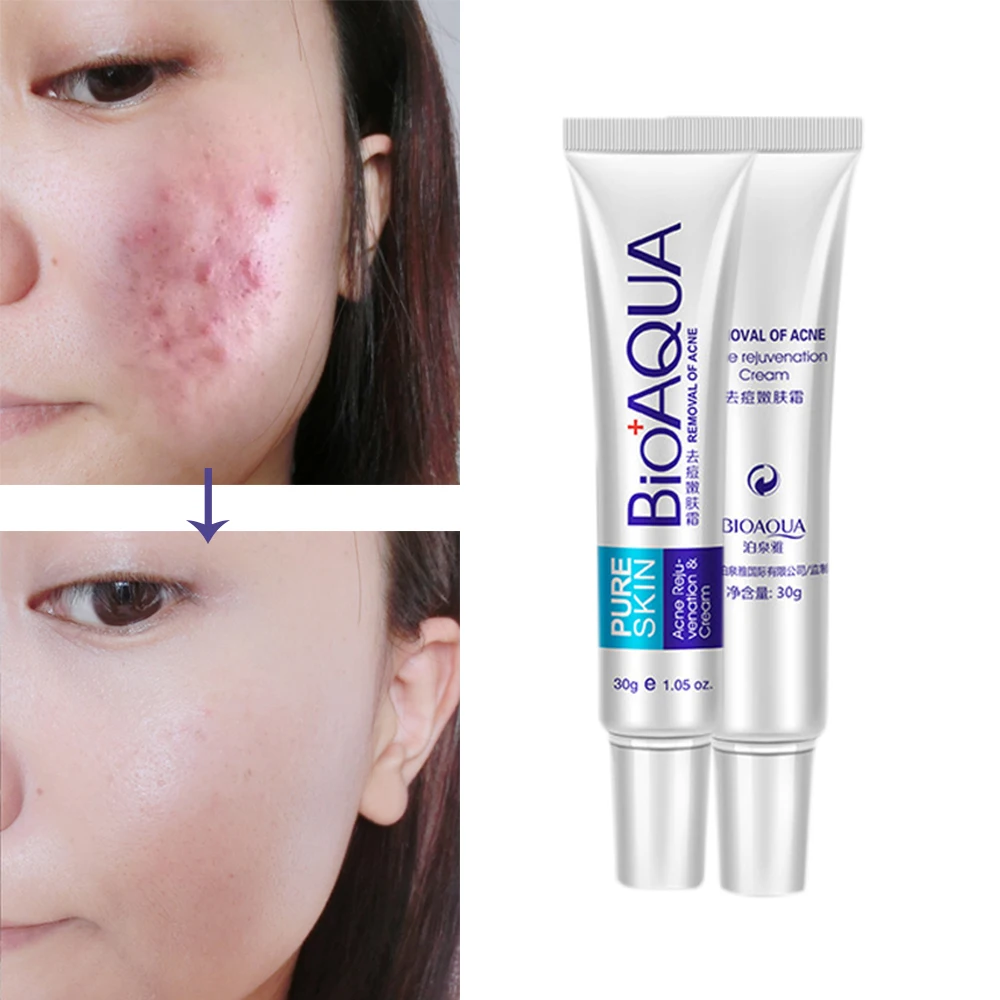 

BIOAQUA Face Acne Treatment Acne Scars C ream Anti Acne Removal Gel Whitening Moisturizing 30g