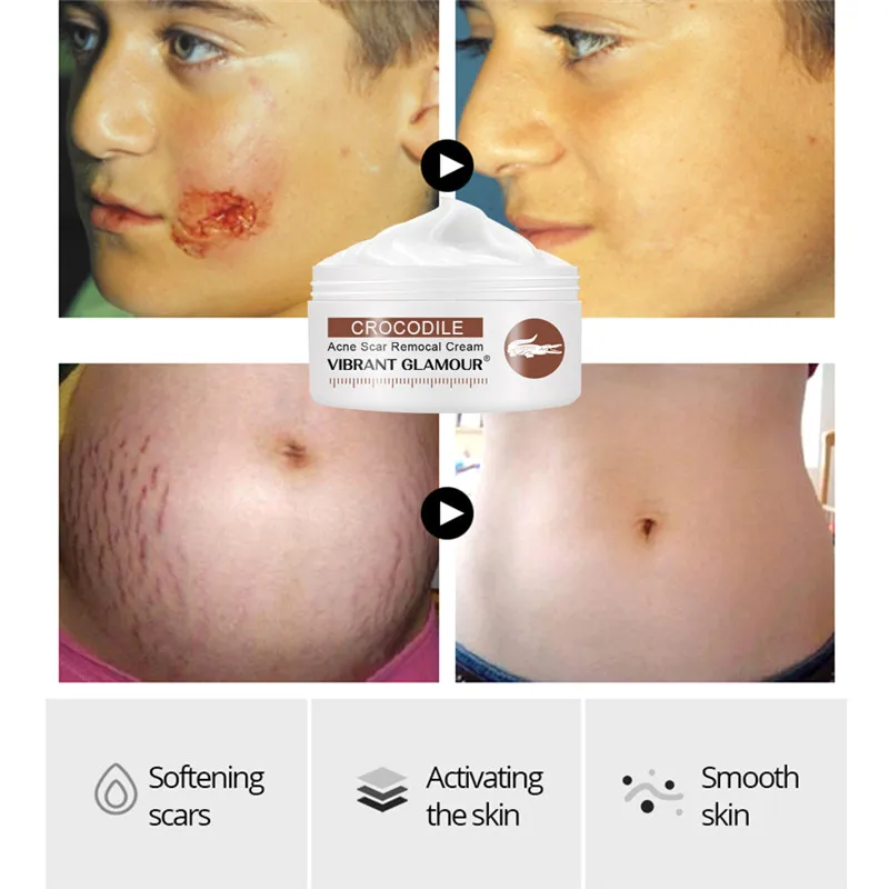 

VIBRANT GLAMOUR Acne Treatment Cream Repair Face Marks Remove Acne Scar Crocodile Whitening For Spots Acne Treatment Stretch