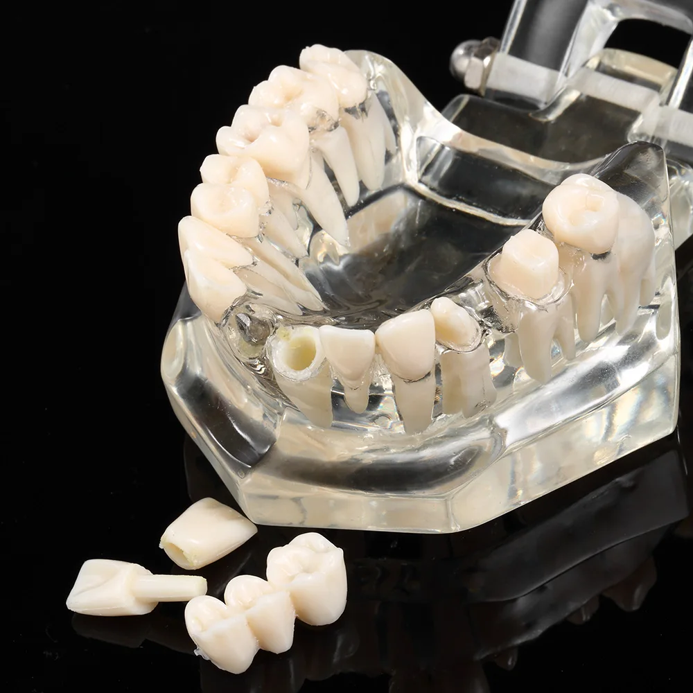 Зубные имплантаты модель зубов с реставрации мост палочки для очистки зубов для медицинских исследований Стоматологическое заболевание обучения, изучения
