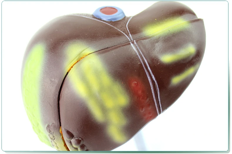 Гепатит B жировая печень цирроз печенья модель пищевая медицина hepatobiliary health