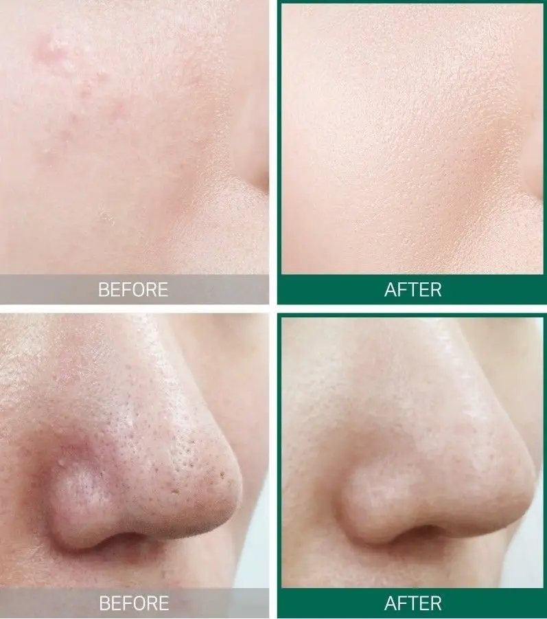 Korea Cosmetics SOME BY ME AHA BHA PHA 30 дней чудо тонер 150 мл Тоник для лица Dead Skin Pores Blackhead лечение