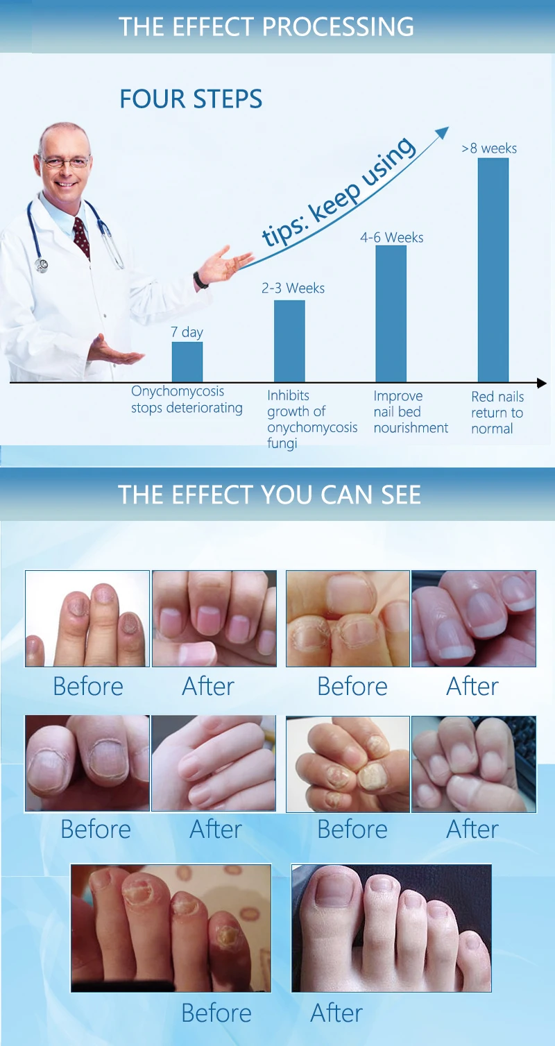 Лечение грибка для ногтей/парониксия онихомикоза/против грибковой инфекции ногтей хороший результат Китайский травяной носок Лечение ногтей масло
