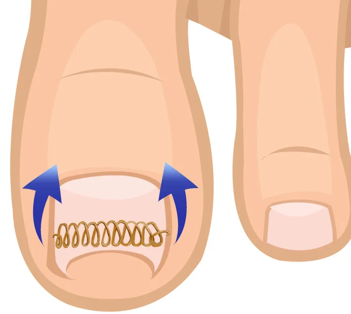 Beauty-Health 12pcs Ingrown Toe Nail Correction Wire Fixer Pedicure Paronychia Recover Toenails Corrector Foot Care Tool