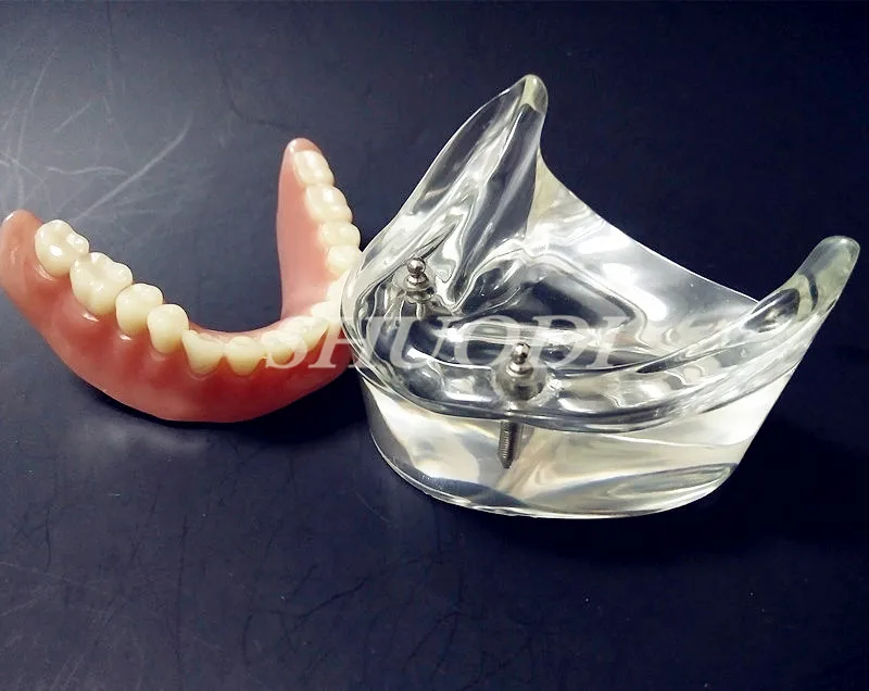 

Dental Overdenture Interior Mandibular Lower with 2 Implants Restoration Teeth Study Teach Model