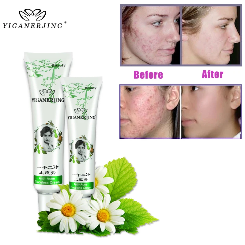 

30g/tube Anti-Acne Cream Ointment Acne Removal Unguent Acne Treatment and Scar Repair 30g Face Skin Care Unisex Adult Skin Care