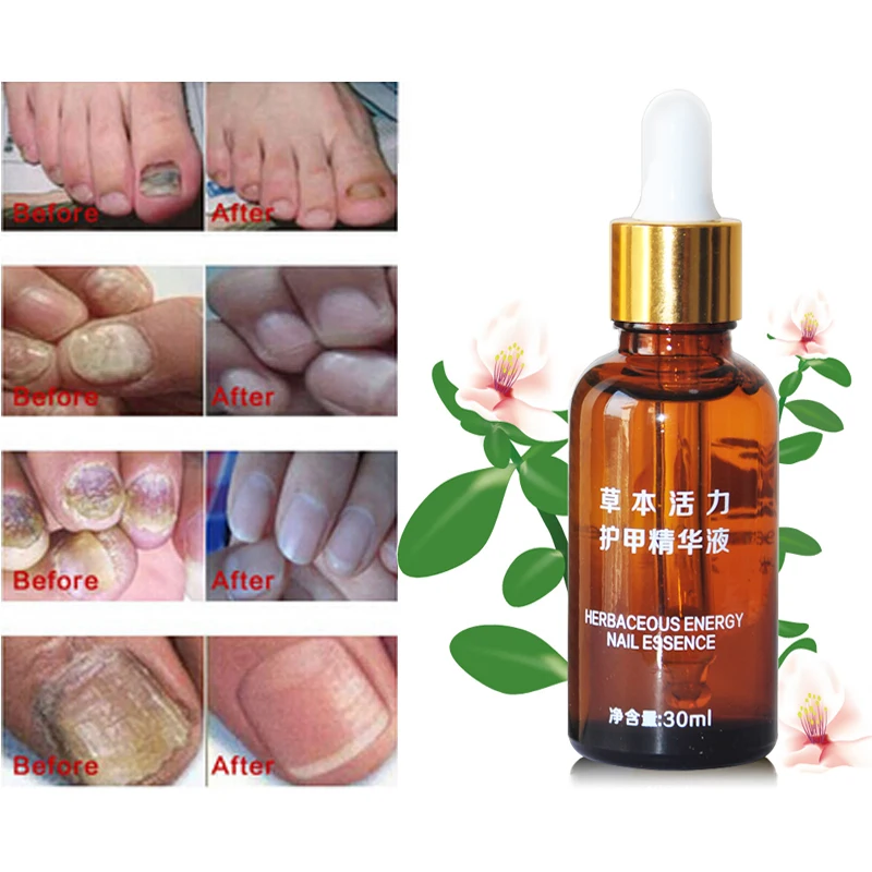

30ML Nail Problem Treatment onychomycosis Repair Nails Nursing Ringworm Nails Bactericide fungicide Nail Regeneration Gel