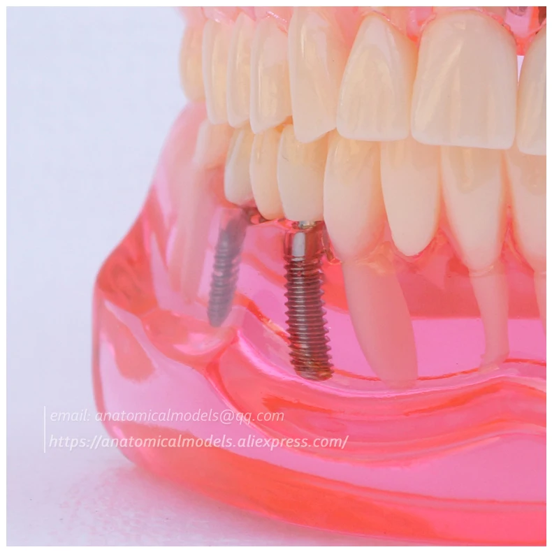 13069 Restoration with Implant 