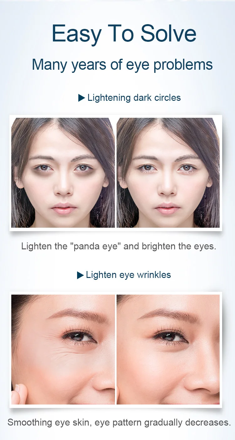 korean dark circles