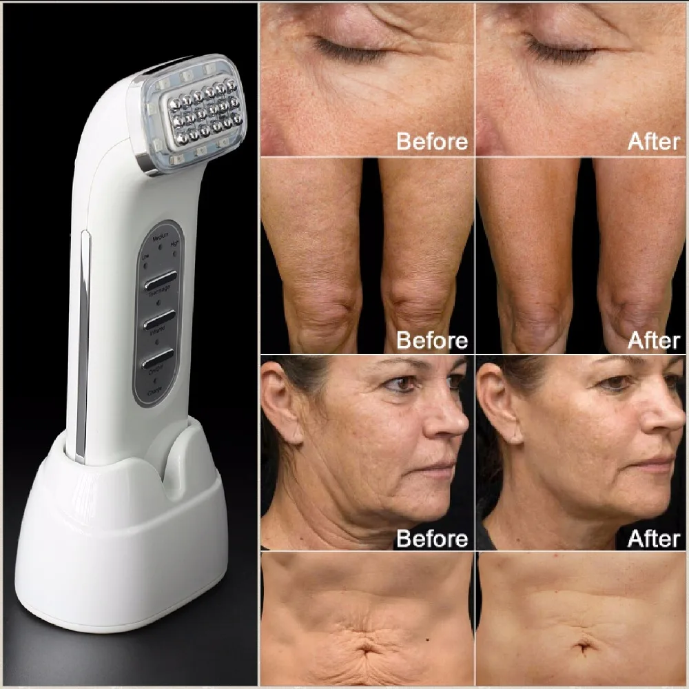 

Real Remove Wrinkles Dot Matrix Facial Radio Frequency Lifting Face Lift Body SKin Care Beauty Device 110-240V