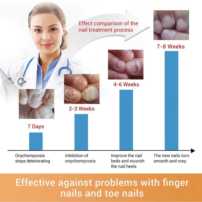 15ml Nail Fungal Treatment With File Anti Fungus Onychomycosis Removal Nails Care Repair Liquid Onychomycosis Treatment Liquid