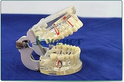 Dental Disease Tooth Teaching Model Pathology Periodontal Diseases Dental Caries Dental Disease Tooth Teaching Model Pathology Periodontal Diseases Dental Caries